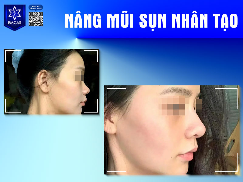 Tuổi thọ của nâng mũi có thể duy trì lên đến 20 năm, thậm chí là vĩnh viễn