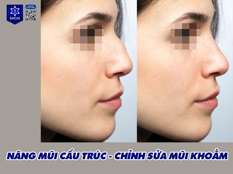 Việc chỉnh sửa tướng mũi khoằm hay không phụ thuộc vào nhiều yếu tố: góc độ thẩm mỹ, phong thuỷ và cả mong muốn cá nhân của mỗi người.