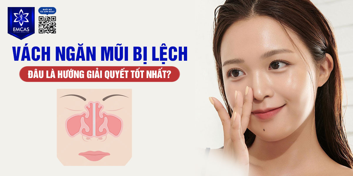 VÁCH NGĂN MŨI BỊ LỆCH LÀ GÌ? NGUYÊN NHÂN VÀ CÁCH KHẮC PHỤC