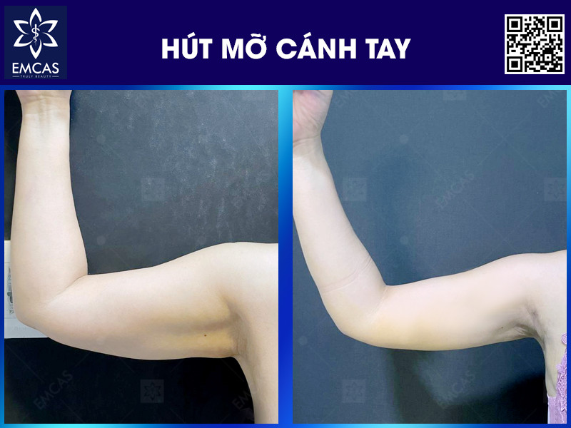 Hút mỡ vùng bắp tay thường phù hợp hơn với người có mỡ thừa cục bộ ở vùng bắp tay, cân nặng tương đối ổn định và sức khỏe đủ điều kiện để can thiệp thẩm mỹ theo đánh giá của bác sĩ.