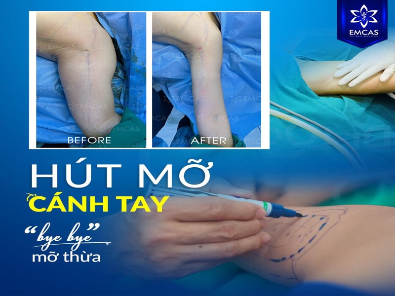 Hút mỡ bắp tay là phẫu thuật thẩm mỹ giúp loại bỏ mỡ thừa cục bộ ở vùng cánh tay trên, từ đó hỗ trợ tạo hình cánh tay thon gọn và cân đối hơn.