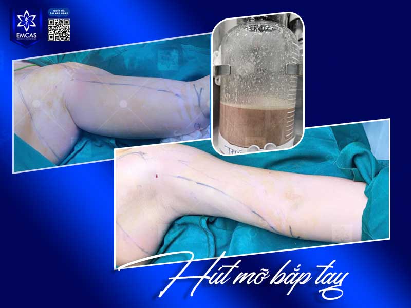 Tư vấn hút mỡ vùng bắp tay tại EMCAS giúp khách hàng được bác sĩ đánh giá trực tiếp tình trạng vùng tay, sức khỏe nền và phương án can thiệp phù hợp trước khi quyết định thực hiện.
