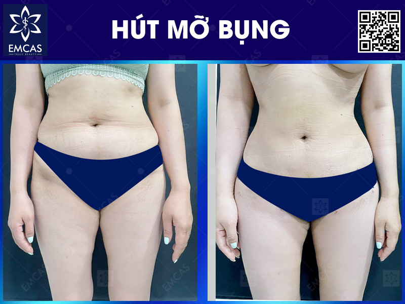 Người phù hợp với hút mỡ bụng thường là người có mỡ bụng khu trú, cân nặng tương đối ổn định, da còn độ đàn hồi và đủ điều kiện sức khỏe