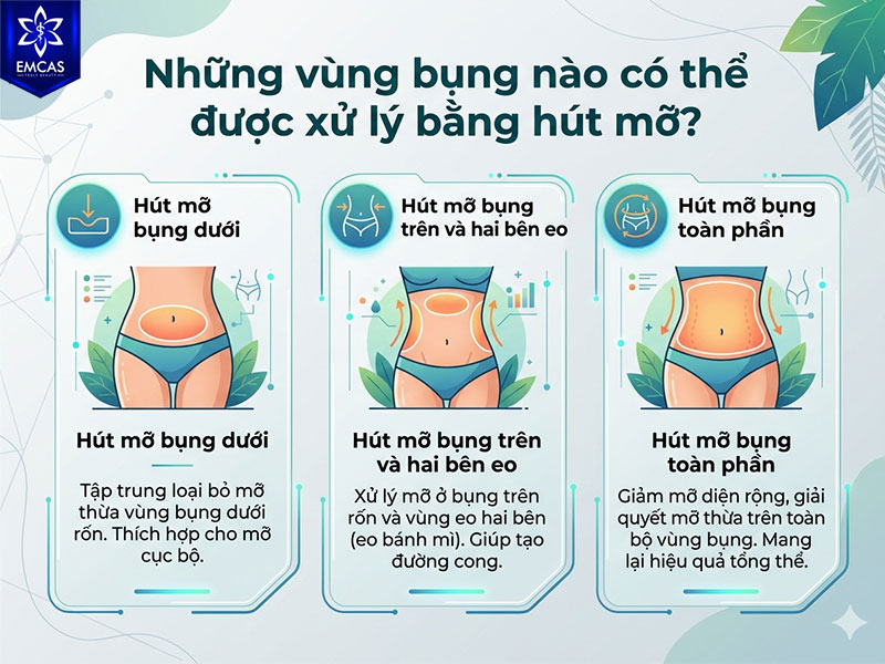 Hút mỡ bụng có thể được lên kế hoạch theo từng vùng như bụng dưới, bụng trên, hai bên eo hoặc toàn bộ vùng bụng