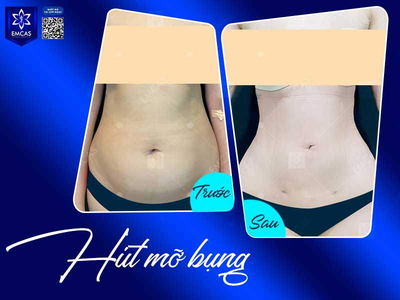 Không nên tự quyết định hút mỡ bụng nếu bạn có bệnh nền, đang dùng thuốc ảnh hưởng đến đông máu, có rủi ro gây mê hoặc có tình trạng da bụng chùng nhiều