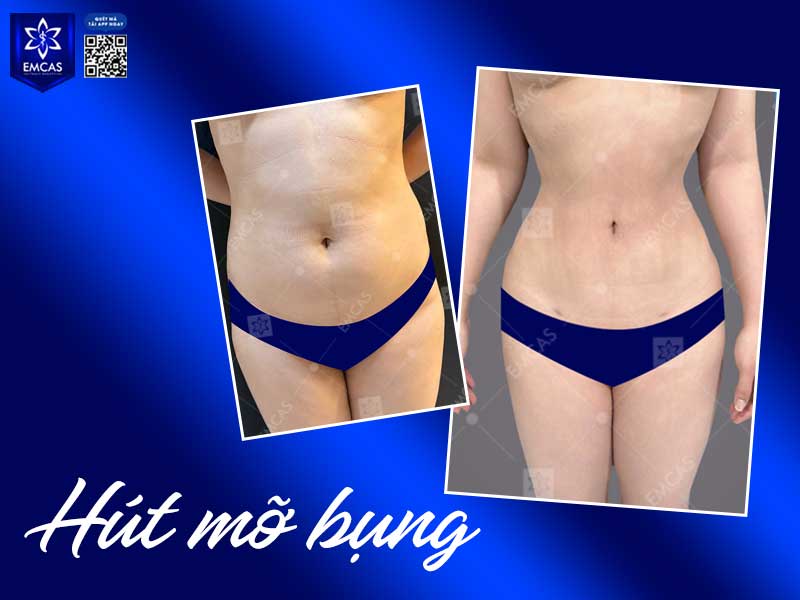 EMCAS là bệnh viện chuyên khoa phẫu thuật thẩm mỹ được cấp phép, có bác sĩ chuyên môn, hệ thống chẩn đoán hình ảnh, công nghệ hút mỡ và phòng mổ chuẩn bệnh viện