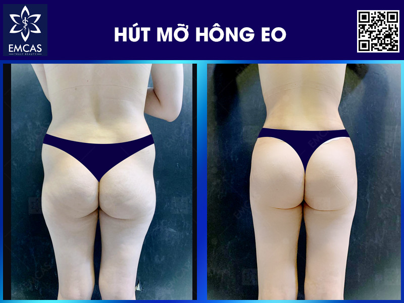 Hút mỡ hông eo có thể giúp giảm đáng kể mỡ thừa ở vùng hông và eo, giúp tạo ra vòng eo thon gọn, săn chắc và quyến rũ hơn. Đồng thời còn giảm nguy cơ mắc các bệnh liên quan đến mỡ thừa.