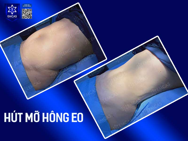 Bệnh viện thẩm mỹ EMCAS là một trong những cơ sở làm đẹp được nhiều người tin tưởng lựa chọn hiện nay với nhiều trang thiết bị tiến tiến, máy móc công nghệ hiện đại