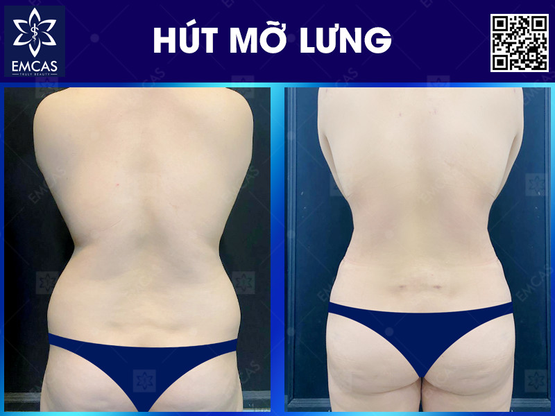 Hút mỡ vùng lưng nhằm loại bỏ mỡ thừa ở vùng lưng, giúp lưng trở nên thon gọn và săn chắc hơn. Điều này có thể giúp bạn tăng sự tự tin hơn về ngoại hình của mình