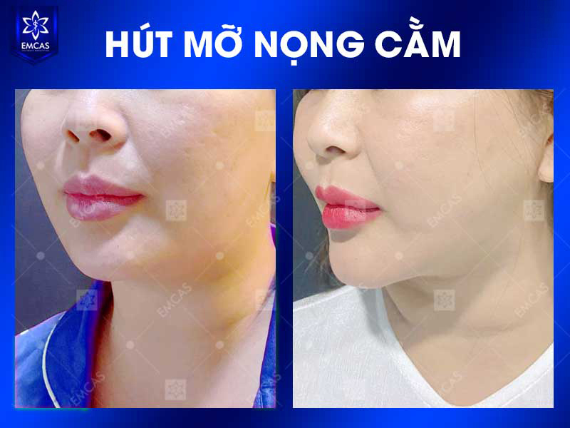 Thăm khám tại EMCAS giúp khách hàng được bác sĩ đánh giá nguyên nhân khiến khuôn mặt trông đầy, xác định vùng mỡ cần xử lý và lựa chọn phương án tạo hình phù hợp