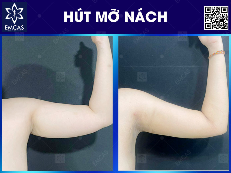Quá trình chăm sóc sau hút mỡ ảnh hưởng lớn đến việc duy trì kết quả