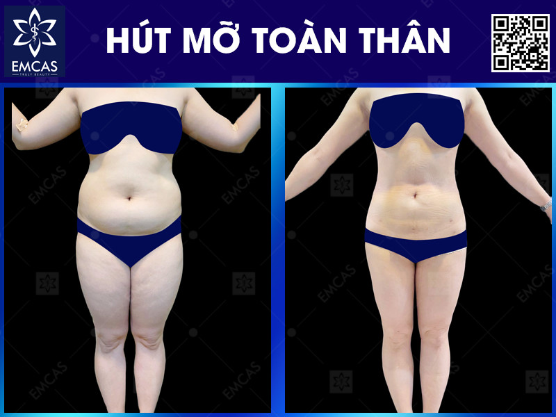Người phù hợp với hút mỡ toàn thân thường là người có mỡ dưới da tích tụ ở nhiều vùng, cân nặng tương đối ổn định và đủ điều kiện sức khỏe để thực hiện phẫu thuật theo đánh giá của bác sĩ.