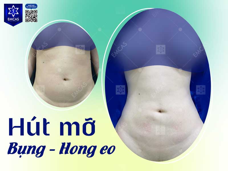 Bệnh Viện Thẩm Mỹ EMCAS là lựa chọn phù hợp với các chị em đang cân nhắc hút mỡ toàn thân