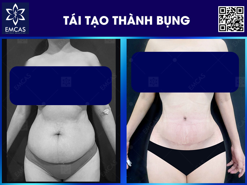 Tạo hình vùng thành bụng có thể được thực hiện an toàn hơn khi khách hàng được thăm khám đúng chỉ định