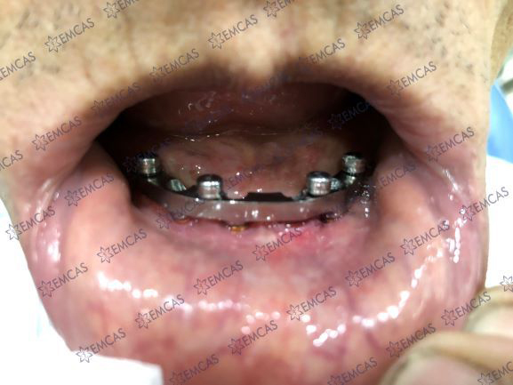CẤY GHÉP IMPLANT TOÀN HÀM