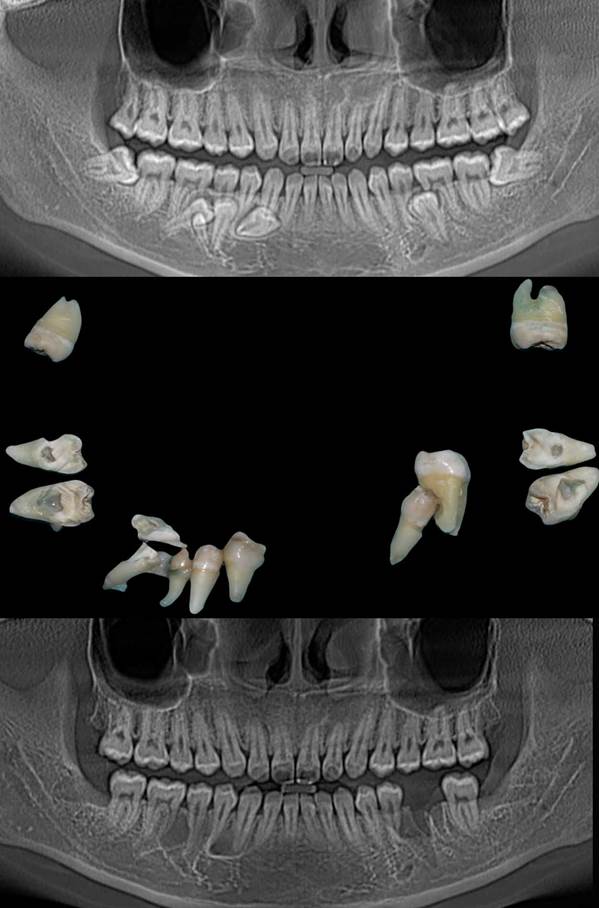 NHỔ RĂNG KHÔNG ĐAU S-TEETH