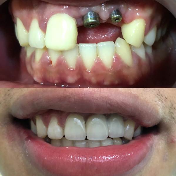 CẤY GHÉP IMPLANT