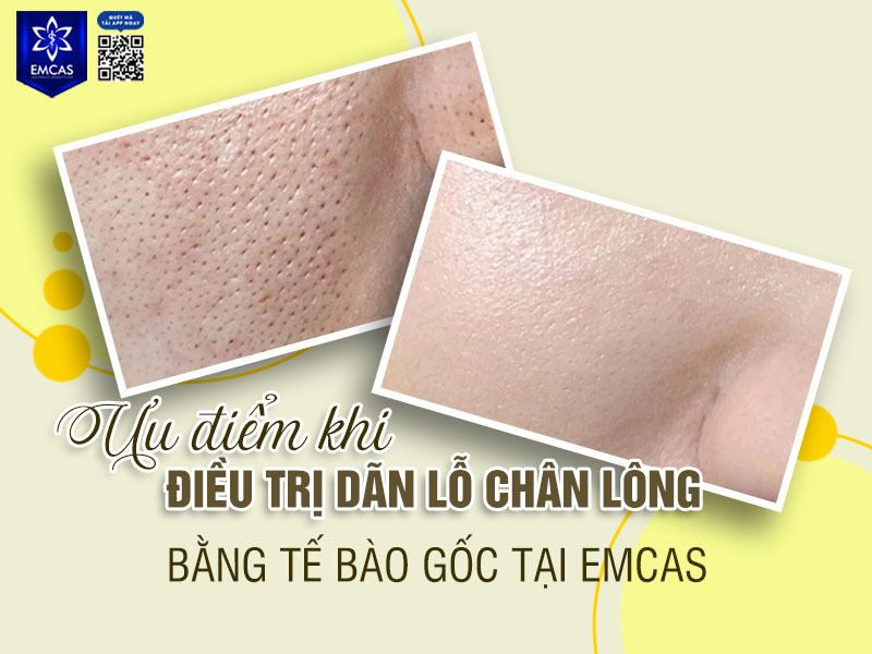 Điều trị dãn lỗ chân lông tại EMCAS được thực hiện theo quy trình chuyên môn, kết hợp công nghệ hiện đại và phác đồ cá nhân hóa nhằm hỗ trợ cải thiện kết cấu da và tối ưu hiệu quả phục hồi cho từng tình trạng da khác nhau.