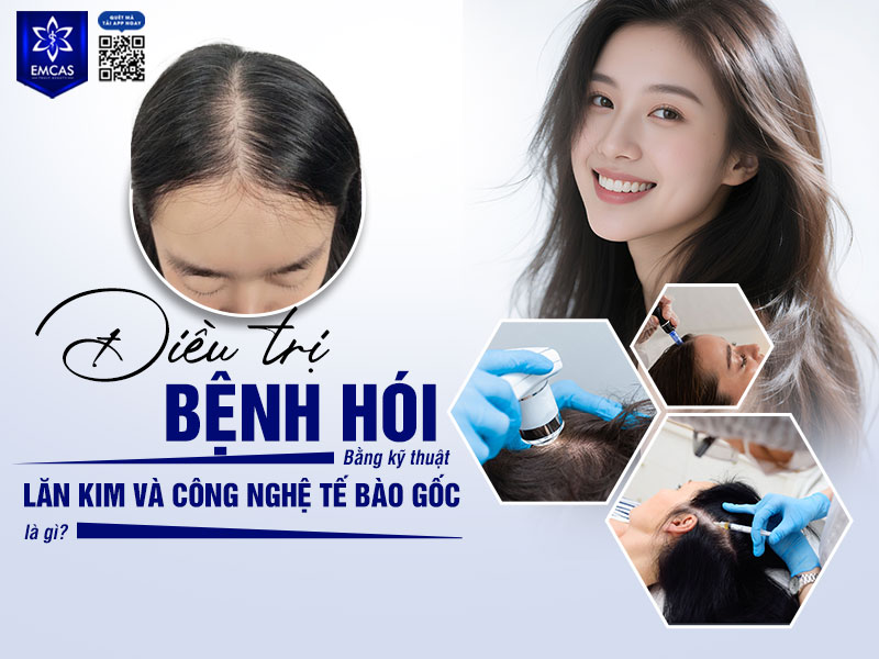 Điều trị bệnh hói bằng kỹ thuật lăn kim và công nghệ tế bào gốc là phương pháp kết hợp giữa lăn kim bề mặt da đầu, peel da và cấy tế bào gốc vào bên dưới da nhằm hỗ trợ cải thiện tình trạng tóc thưa, hói và nang tóc suy yếu từ sâu bên trong.