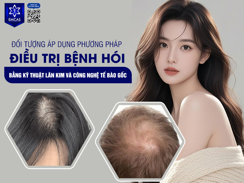 Điều trị bệnh hói bằng kỹ thuật lăn kim và công nghệ tế bào gốc là lựa chọn phù hợp cho những trường hợp tóc thưa, tóc yếu hoặc nang tóc suy giảm hoạt động.
