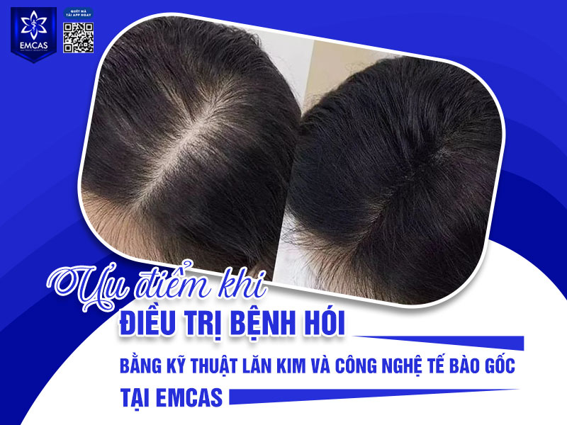 Tại Bệnh Viện Thẩm Mỹ EMCAS, dịch vụ điều trị bệnh hói bằng kỹ thuật lăn kim và công nghệ tế bào gốc được xây dựng theo hướng cá nhân hóa, kết hợp công nghệ hiện đại và quy trình chuẩn y khoa.