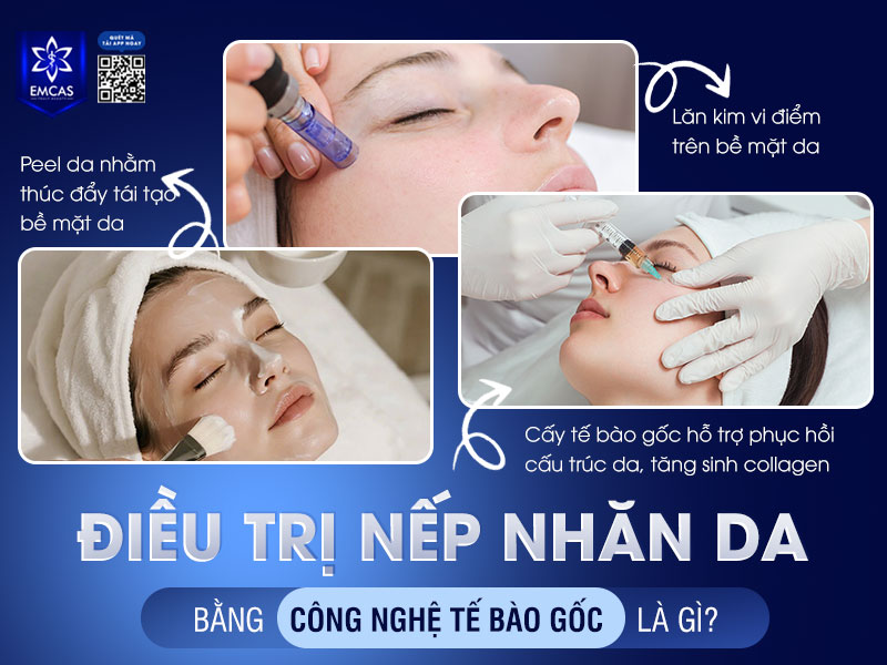 Điều trị nếp nhăn da bằng kỹ thuật lăn kim và công nghệ tế bào gốc là phương pháp kết hợp giữa lăn kim vi điểm trên bề mặt da với peel da và cấy tế bào gốc nhằm cải thiện các dấu hiệu lão hóa từ sâu bên trong.