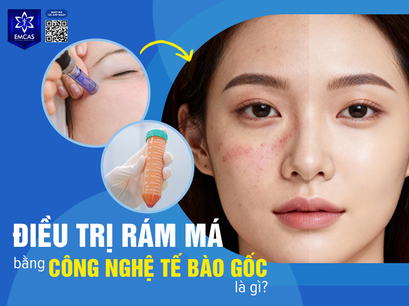 Điều trị rám má bằng kỹ thuật lăn kim và công nghệ tế bào gốc là phương pháp kết hợp giữa lăn kim bề mặt da, peel da và cấy tế bào gốc nhằm hỗ trợ cải thiện sắc tố da từ bên trong.