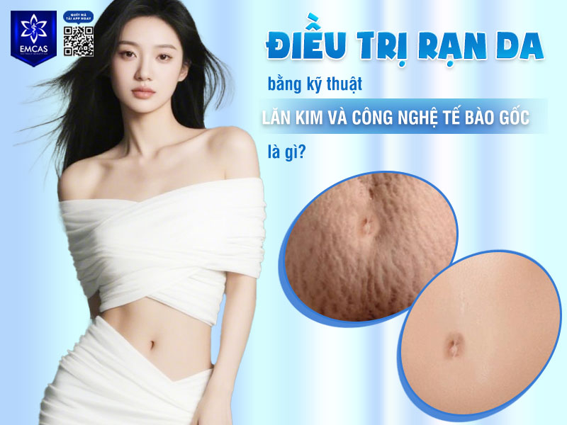 Điều trị rạn da bằng kỹ thuật lăn kim và công nghệ tế bào gốc không chỉ tác động lên bề mặt da mà còn hỗ trợ tái tạo da từ bên trong.