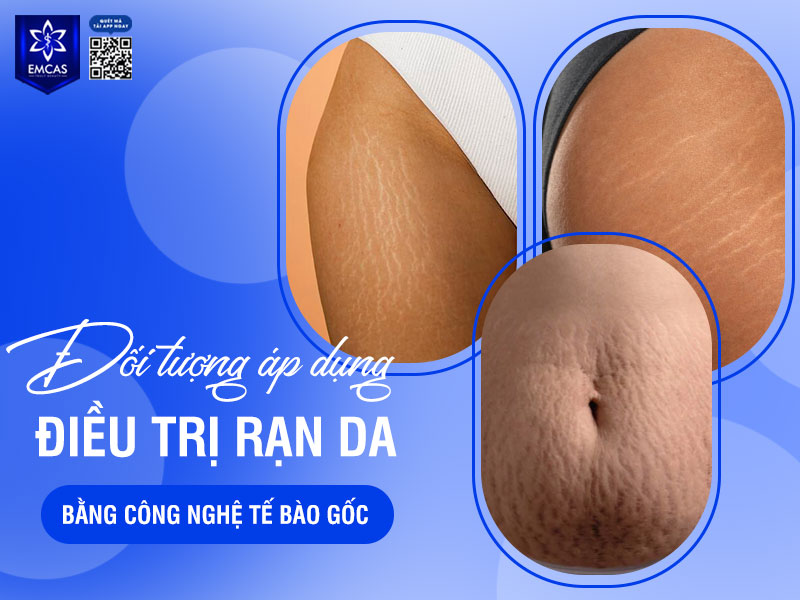 Phương pháp điều trị rạn da bằng kỹ thuật lăn kim và công nghệ tế bào gốc thường được áp dụng cho người bị rạn da sau sinh, tăng hoặc giảm cân nhanh.