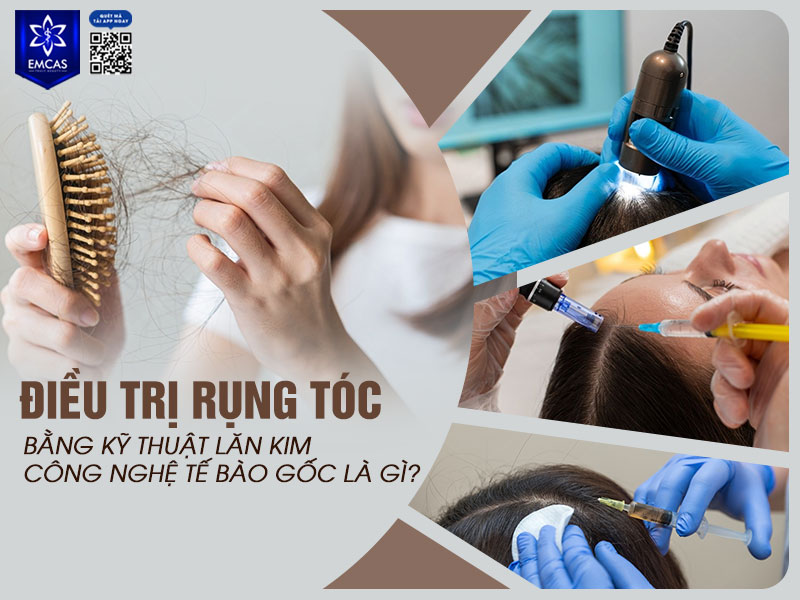 Điều trị rụng tóc ứng dụng kỹ thuật lăn kim vi điểm trên bề mặt da đầu nhằm tạo ra những kích thích sinh học tự nhiên, giúp tăng tuần hoàn máu và “đánh thức” các nang tóc suy yếu.