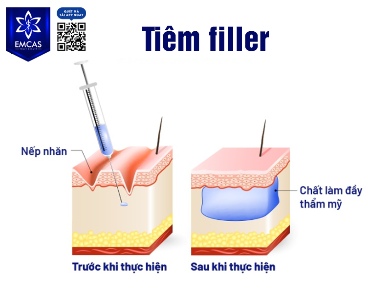 Có Nên Tiêm Filler Nâng Mông Không?