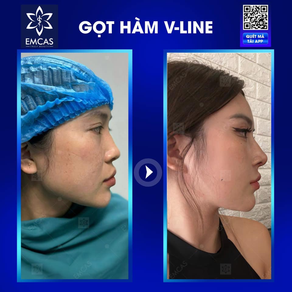 Tất Tần Tật Về Gọt Hàm: Quy Trình, Ưu Điểm và Chăm Sóc