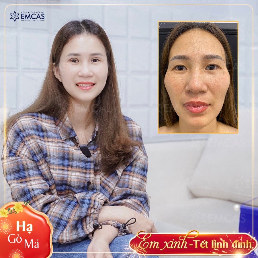 Tại Sao Nên Chọn Dịch Vụ Hạ Gò Má Lefort Để Cải Thiện Nhan Sắc?