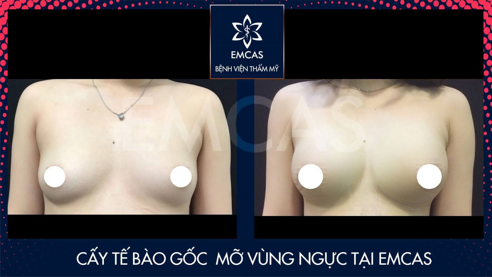Nâng Ngực Kết Hợp Bổ Sung Mỡ Tại EMCAS