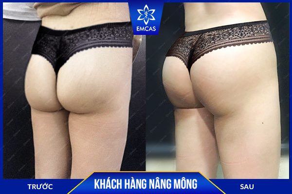 Nâng Mông Bao Lâu Thì Ngồi Được?