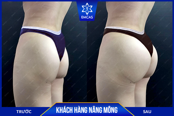 Khi Nào Nên Chọn Nâng Mông Bằng Túi Độn?