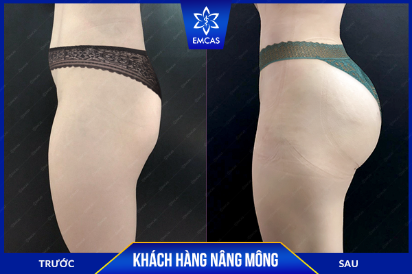 Cách Chăm Sóc Sau Phẫu Thuật Nâng Mông