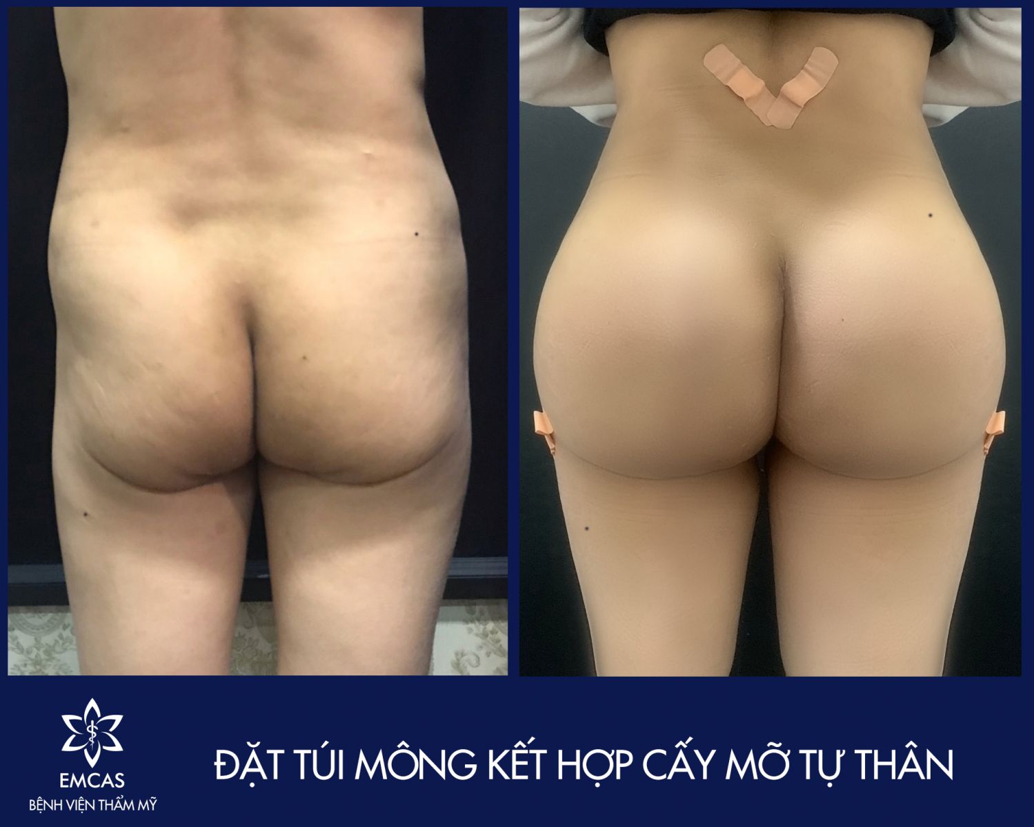 Nâng Mông Bao Lâu Thì Ngồi Được?