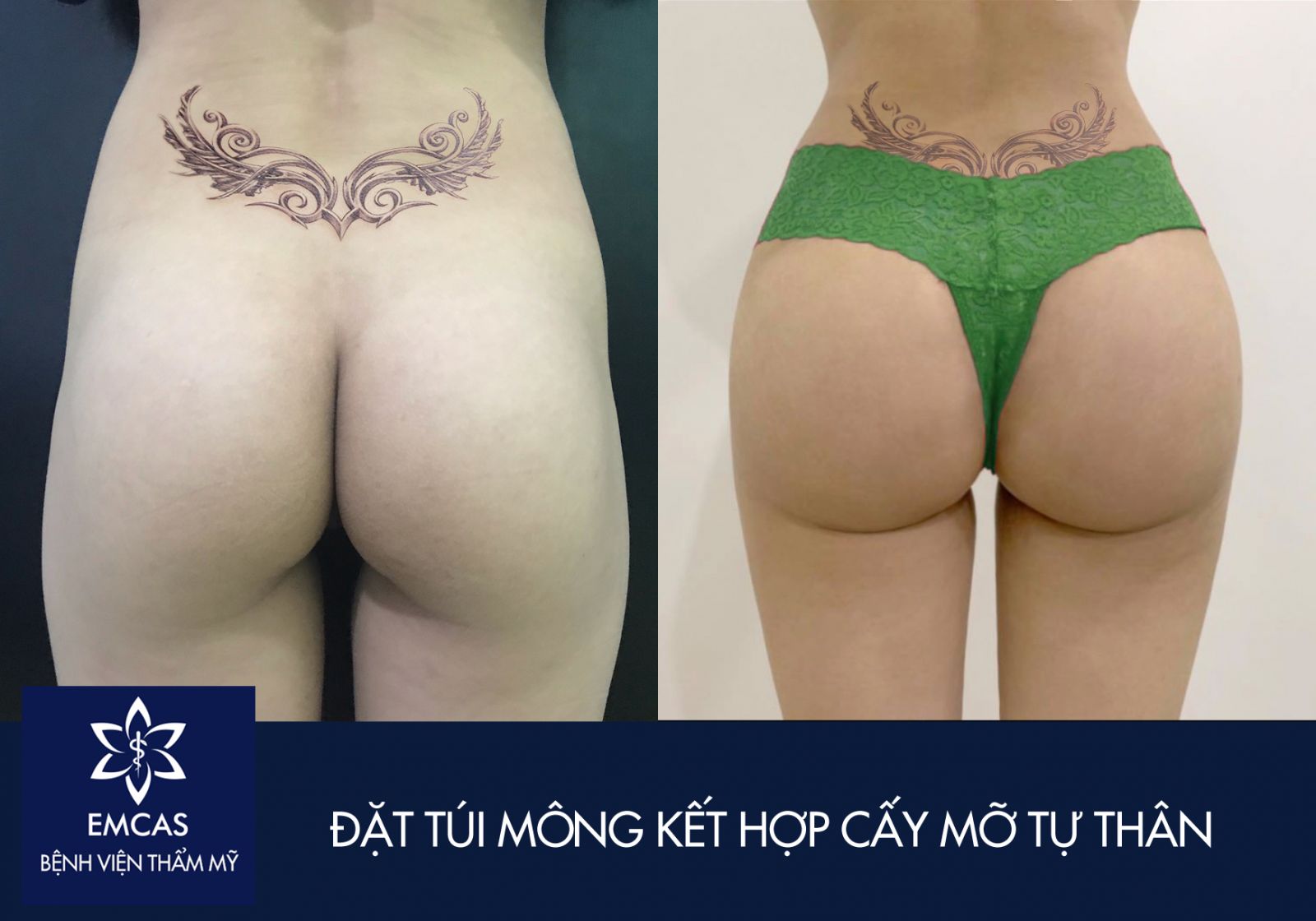 Bảo Quản Vẻ Đẹp - Nâng Mông Bằng Mỡ Tự Thân Giữ Được Bao Lâu?