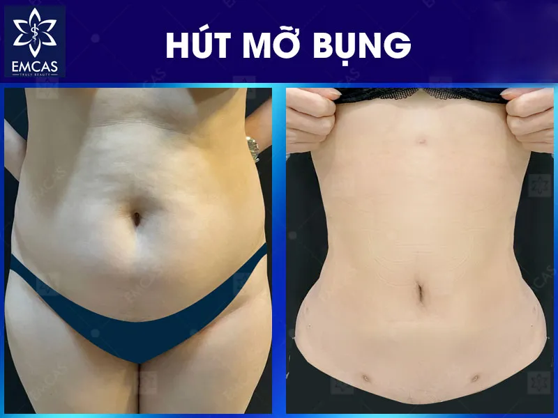 Tại Bệnh Viện Thẩm Mỹ EMCAS, hút mỡ bụng bắt đầu từ đánh giá cá nhân hóa về thể trạng