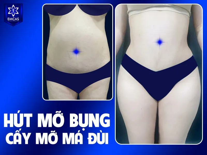 Khi lựa chọn địa chỉ hút mỡ bụng tại TPHCM, bạn nên ưu tiên bệnh viện được cấp phép