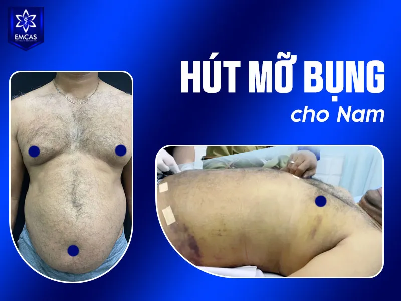 Khi chọn địa chỉ hút mỡ bụng nam tại TPHCM, bạn nên ưu tiên cơ sở được cấp phép phù hợp