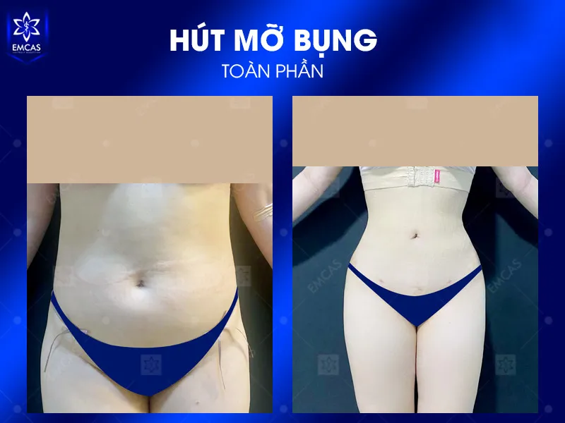 Bệnh Viện Thẩm Mỹ EMCAS là một trong những địa chỉ đáng tin cậy để thăm khám hút mỡ bụng tại TPHCM