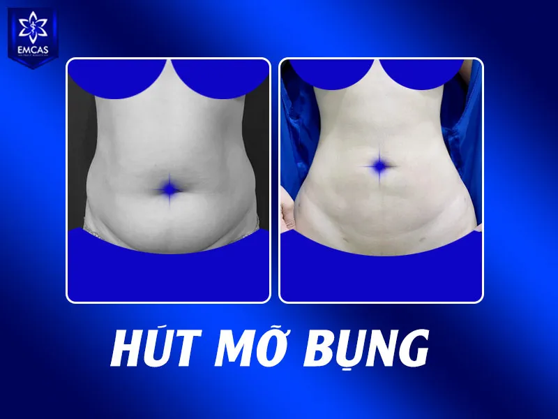 Khi đi tư vấn hút mỡ bụng, bạn nên hỏi rõ về chỉ định, bác sĩ thực hiện