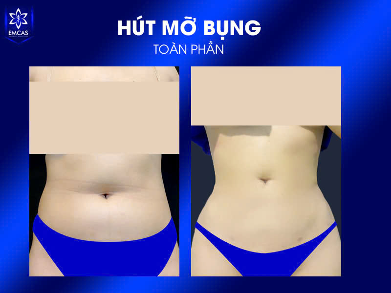 Hút mỡ không phải là phương pháp giảm cân, vì mục tiêu chính của phương pháp này là loại bỏ mỡ khu trú và cải thiện đường nét cơ thể thay vì làm giảm cân nặng toàn thân.