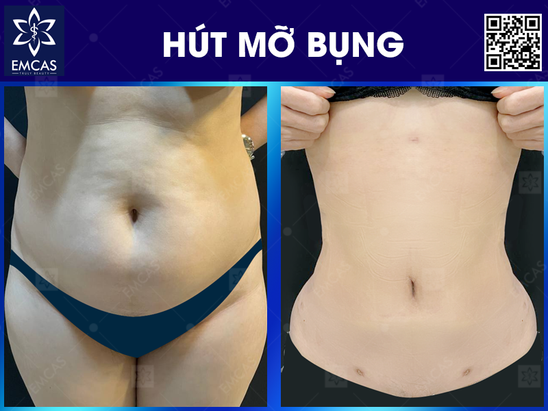 Tìm Hiểu Kỹ Hơn Về Các Dịch Vụ Hút Mỡ Hiện Nay