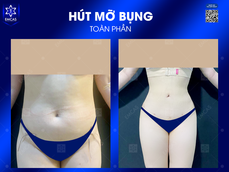 Những Điều Cần Biết Khi Hút Mỡ Bụng