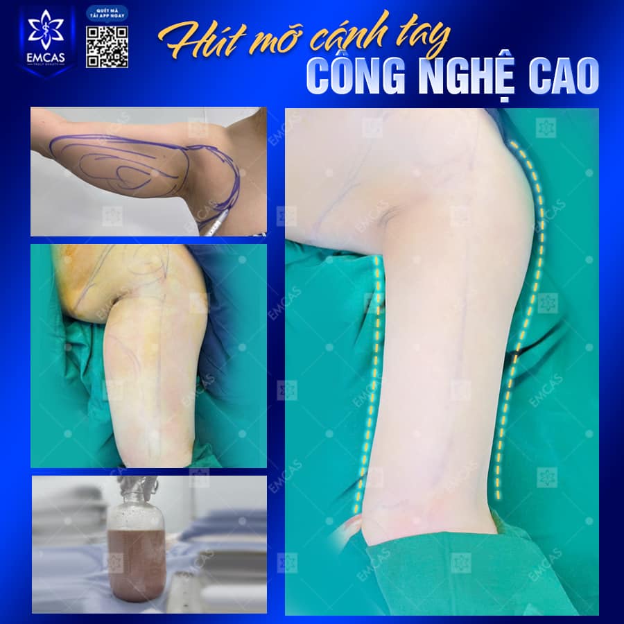 Hút Mỡ Bắp Tay - Phương Pháp Giúp Cánh Tay Săn Chắc, Không Chảy Xệ