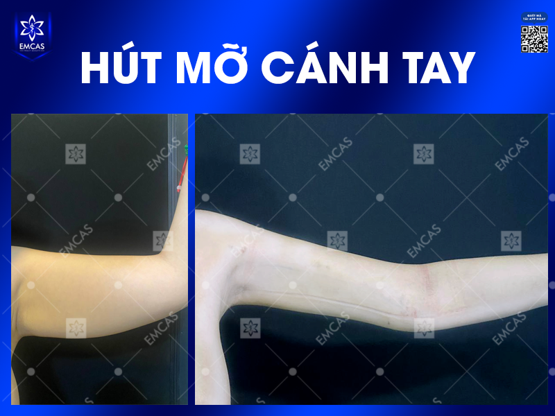 Hút Mỡ Cánh Tay - Giải Pháp Hiệu Quả Cho Đôi Tay Thon Gọn