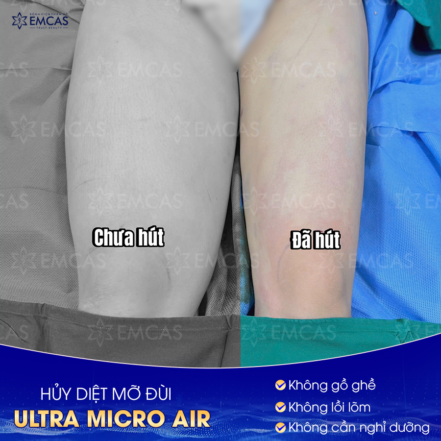 Tìm Hiểu Kỹ Hơn Về Các Dịch Vụ Hút Mỡ Hiện Nay
